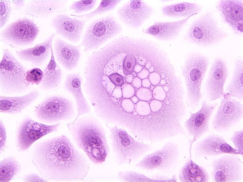 Relación entre Virus de papiloma humano (VPH) y el cáncer